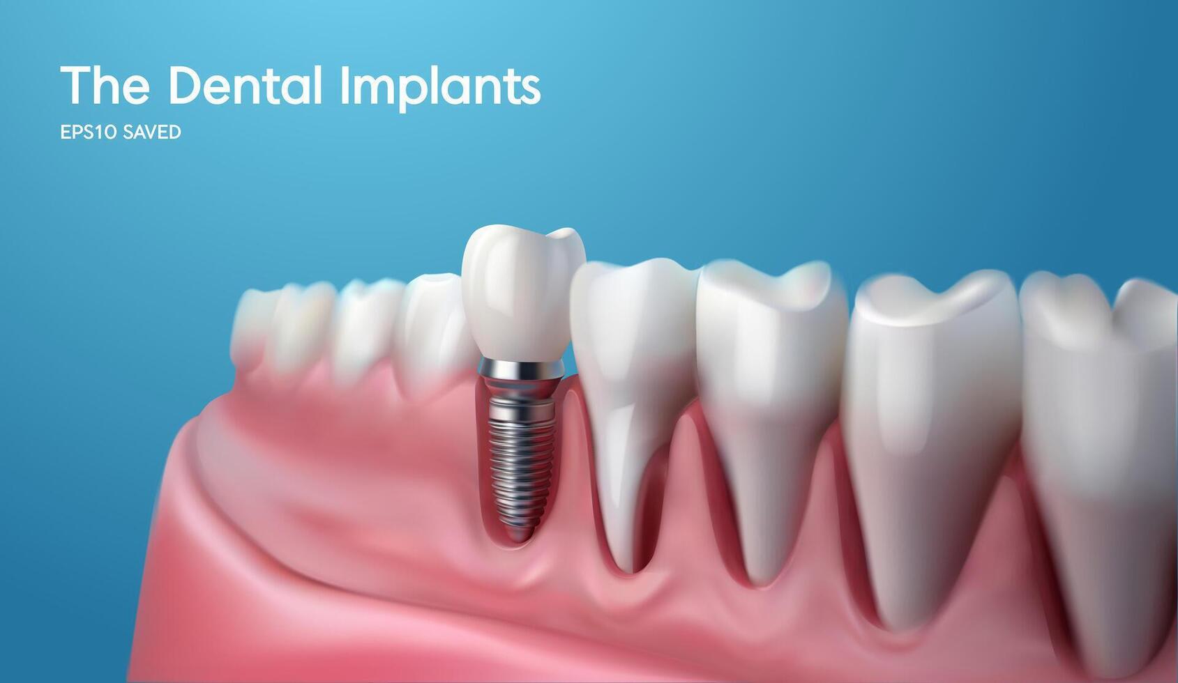 White tooth implant implant cut, healthy tooth or dental surgery. vector