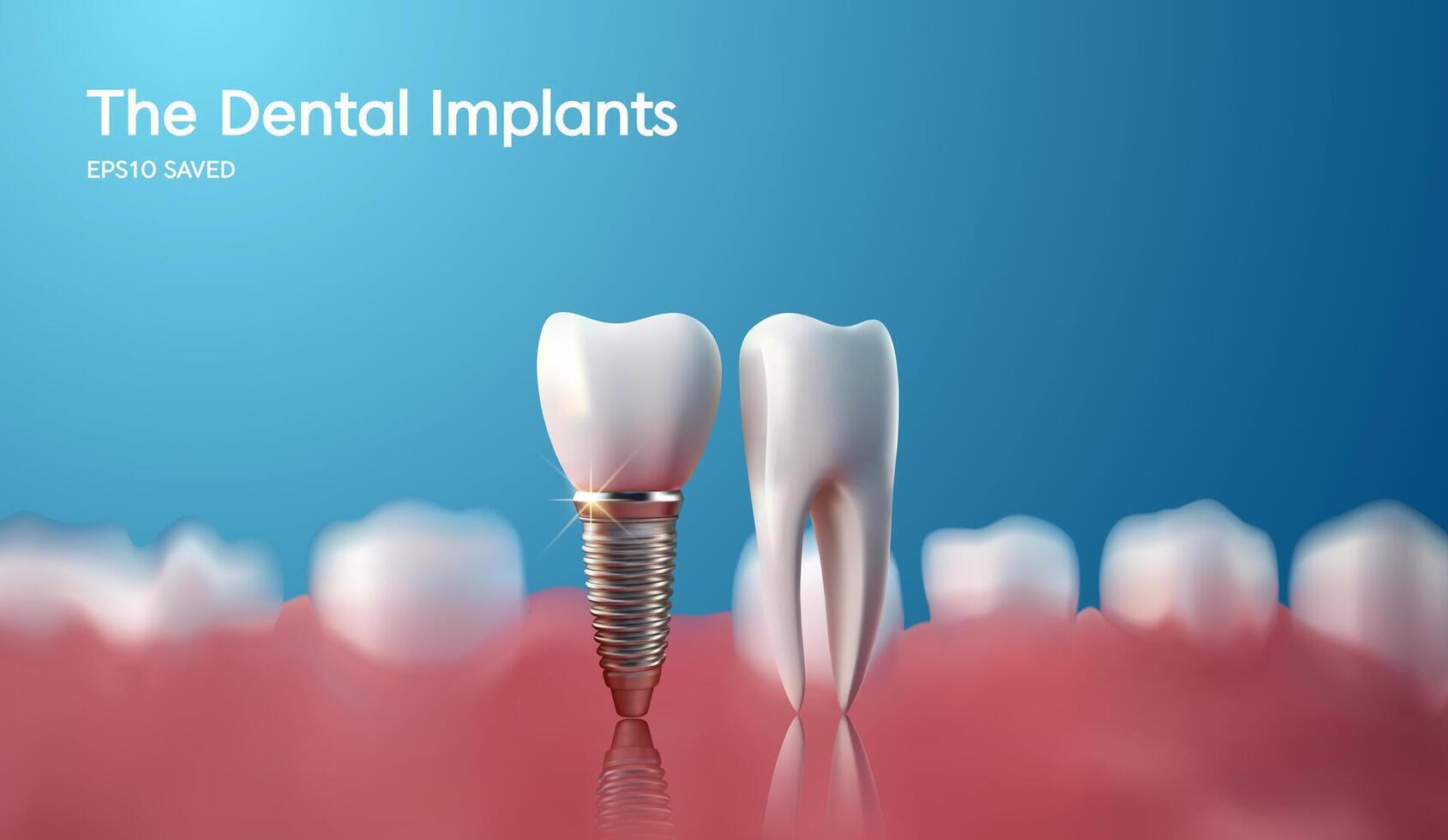 blanco diente implante implante cortar, sano diente o dental cirugía. vector