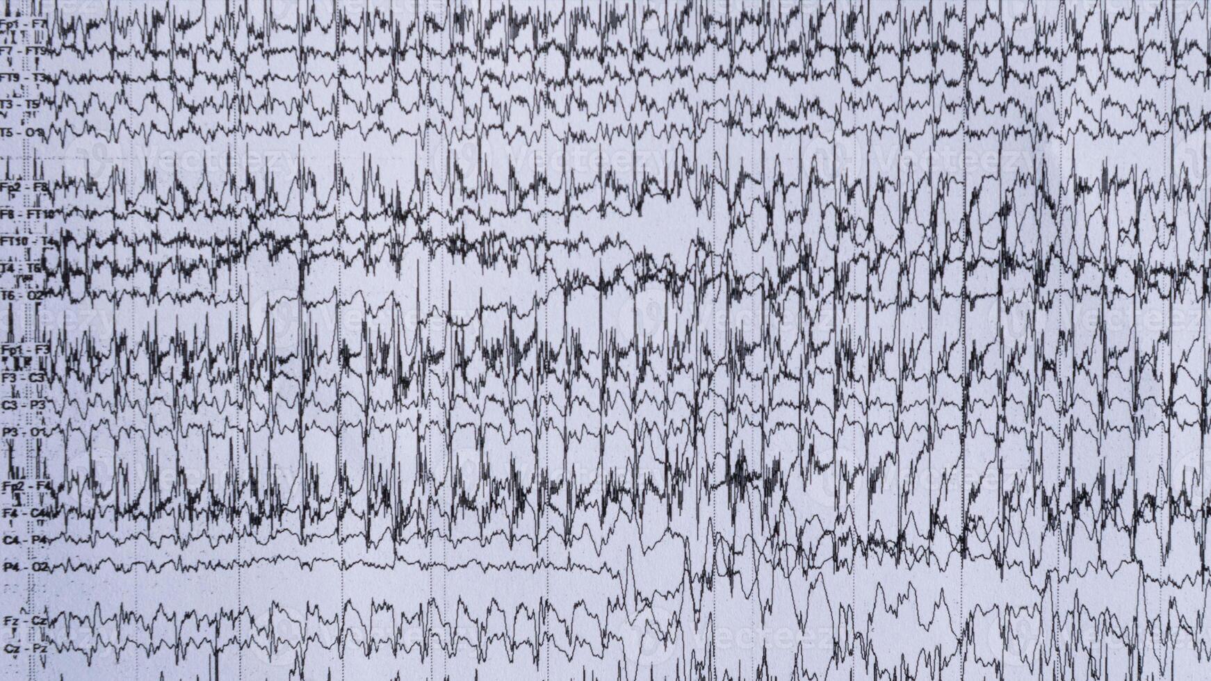 imagen de ictal eeg grabación en epilepsia paciente foto