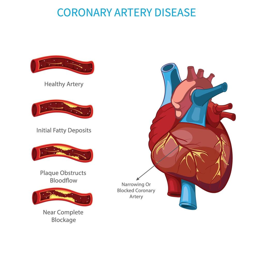 In Coronary artery disease, Narrowing of coronary arteries occur, which increases risk of heart attack vector