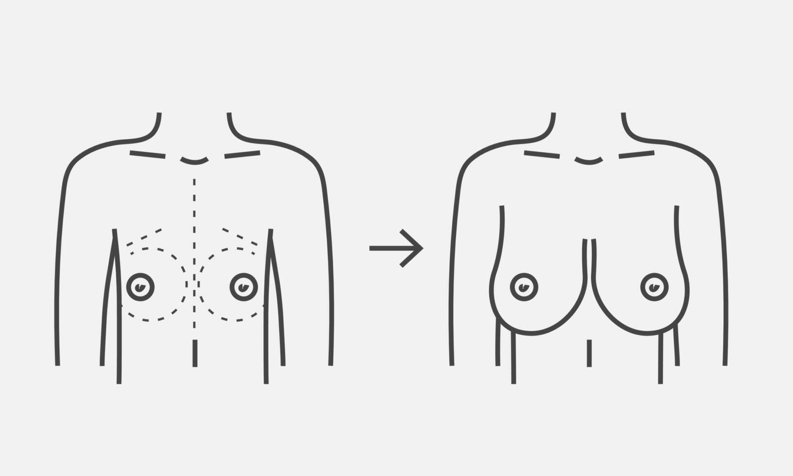 Female breast before and after augmentation line icon. Plastic surgery breast size correction. Vector illustration