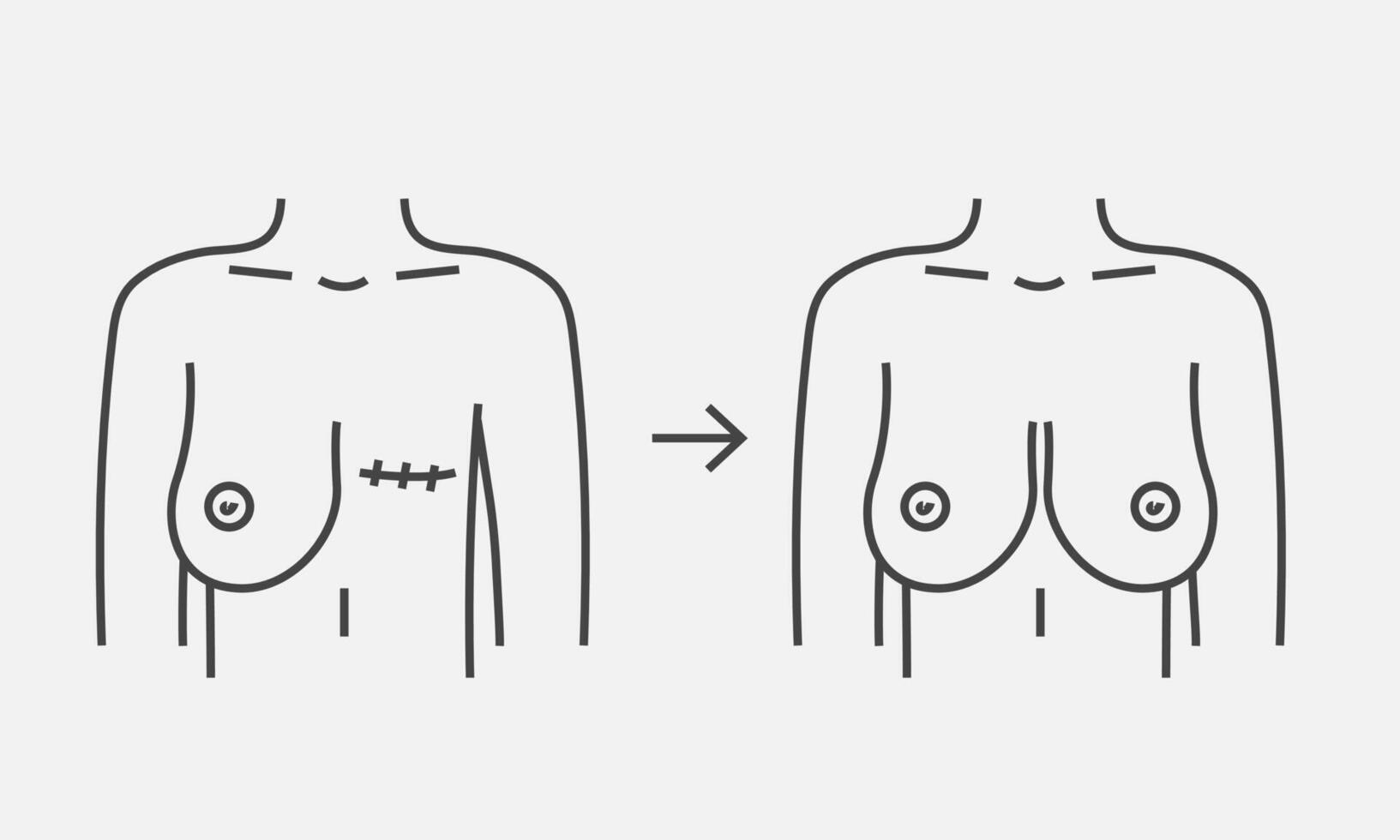 Mastectomy breast cancer and breast reconstruction. Mammary cancer, mastectomy. Vector illustration