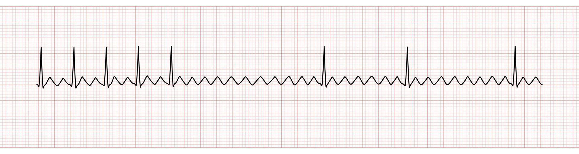 EKG Monitor Showing Atrial Flutter with 2 to 1 AV Block After Adenosine ...