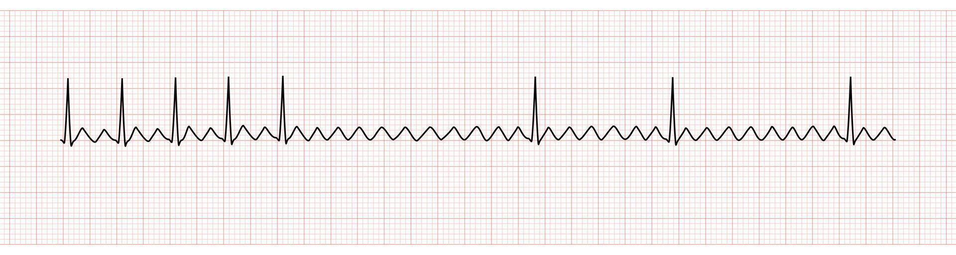 EKG Monitor Showing  Atrial Flutter with 2 to 1 AV Block After Adenosine Intravenous vector