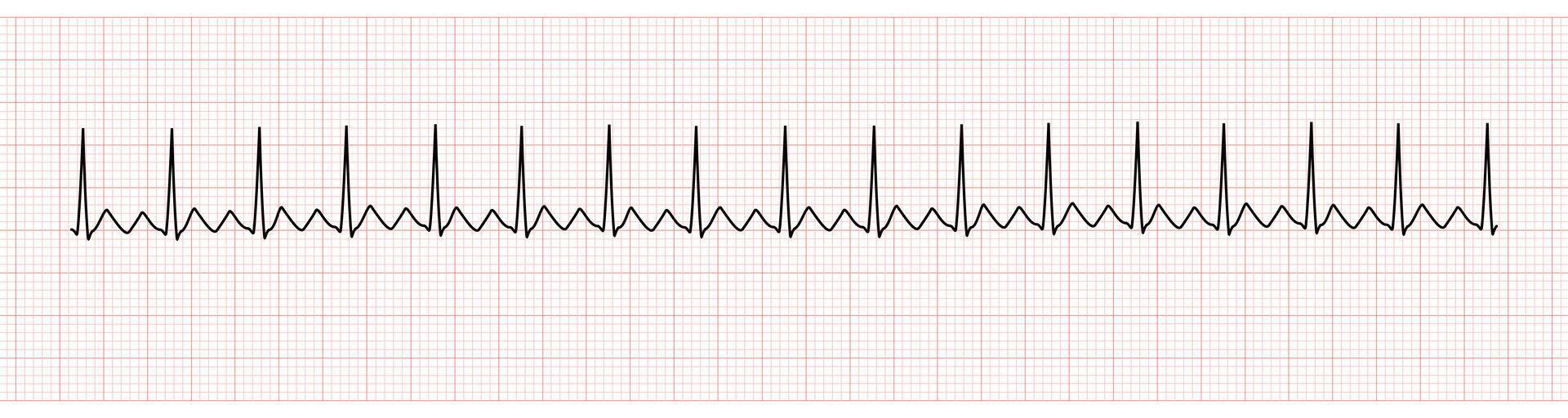 EKG Monitor Showing Atrial Flutter with 2 to 1 AV Block 42268620 Vector ...