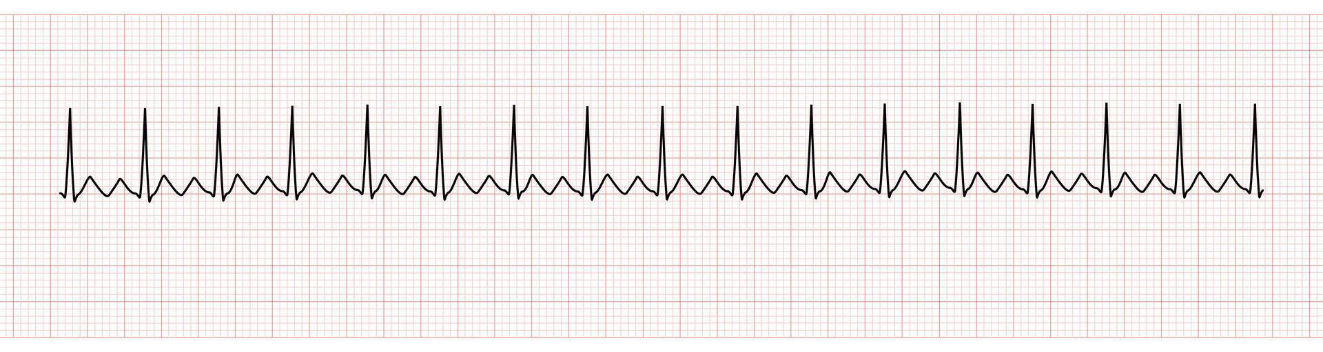 EKG Monitor Showing  Atrial Flutter with 2 to 1 AV Block vector