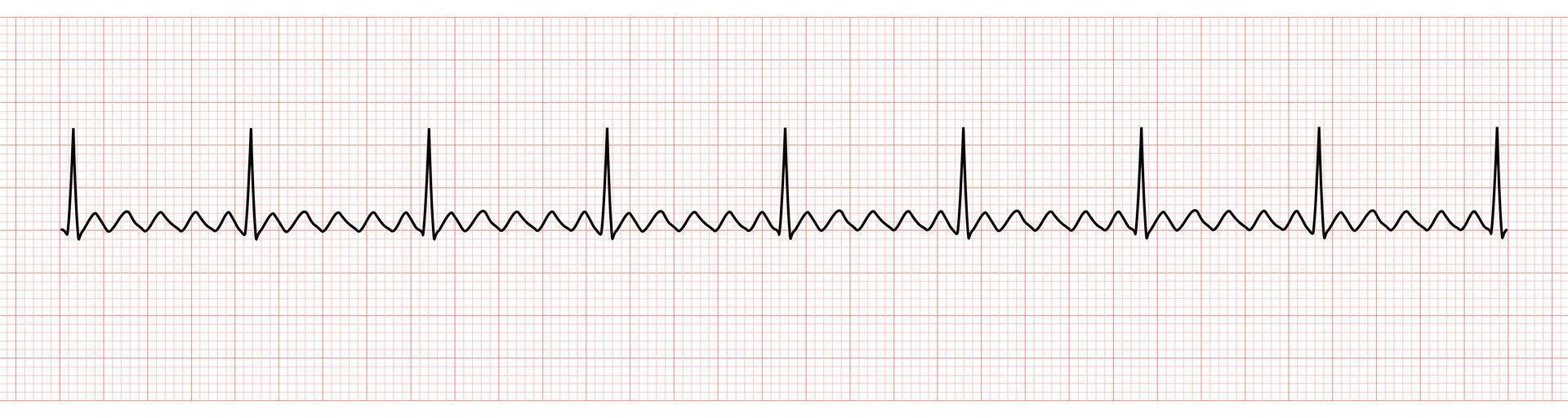 EKG Monitor Showing  Atrial Flutter vector