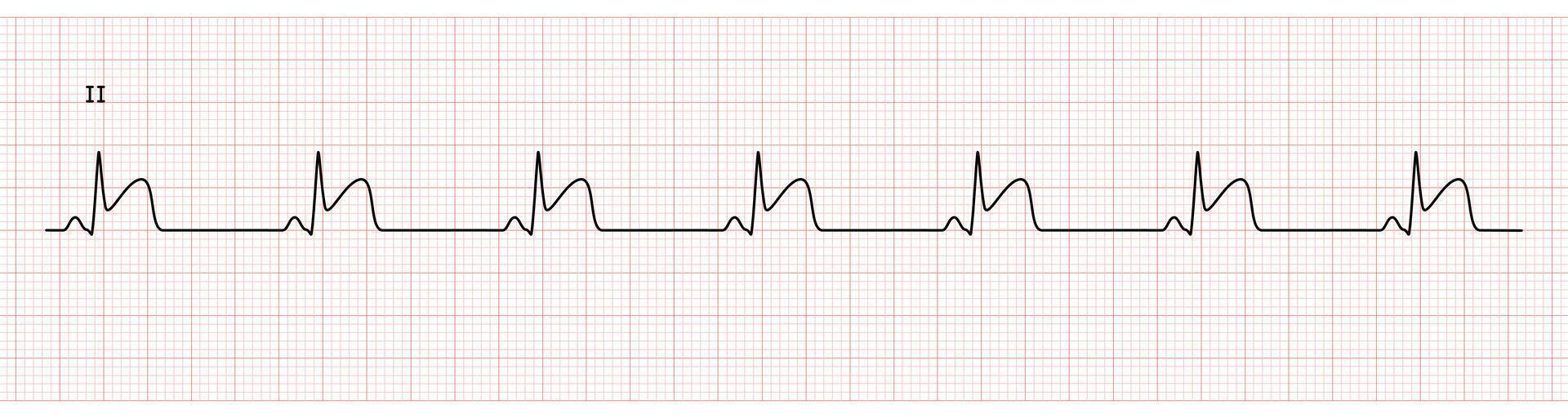 EKG Monitor in lead II Showing  Sinus Rhythm with STEMI at Inferior Wall vector