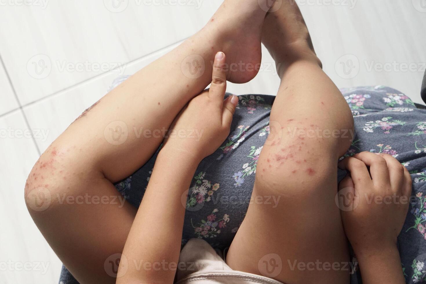 Boy showing his knee infected with hand feet and mouth disease or HFMD originating from enterovirus or coxsackie virus, top view zoom shot. photo