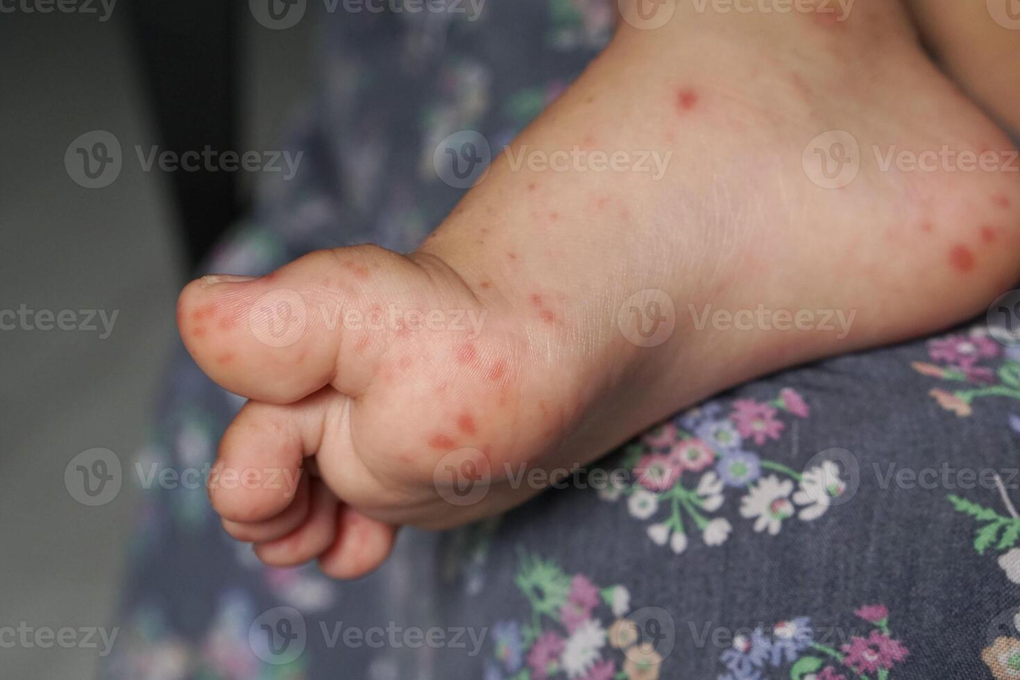 Close up view of child's feet infected with hand feet and mouth disease or HFMD originating from enterovirus or coxsackie virus, close up view zoom shot. photo