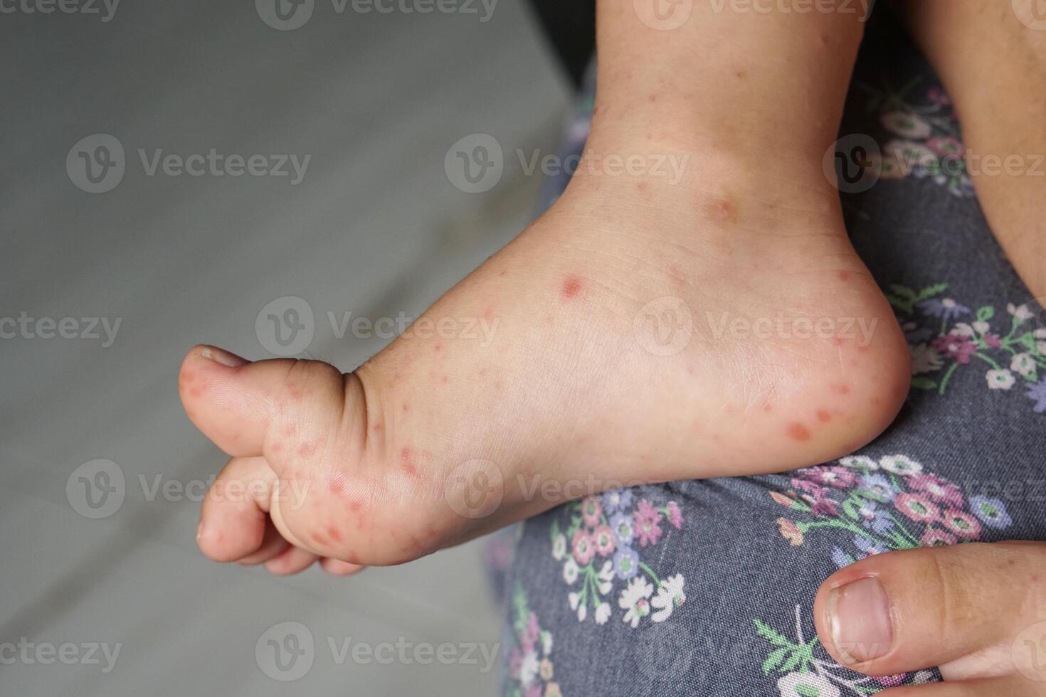 Close up view of child's feet infected with hand feet and mouth disease or HFMD originating from enterovirus or coxsackie virus, close up view zoom shot. photo