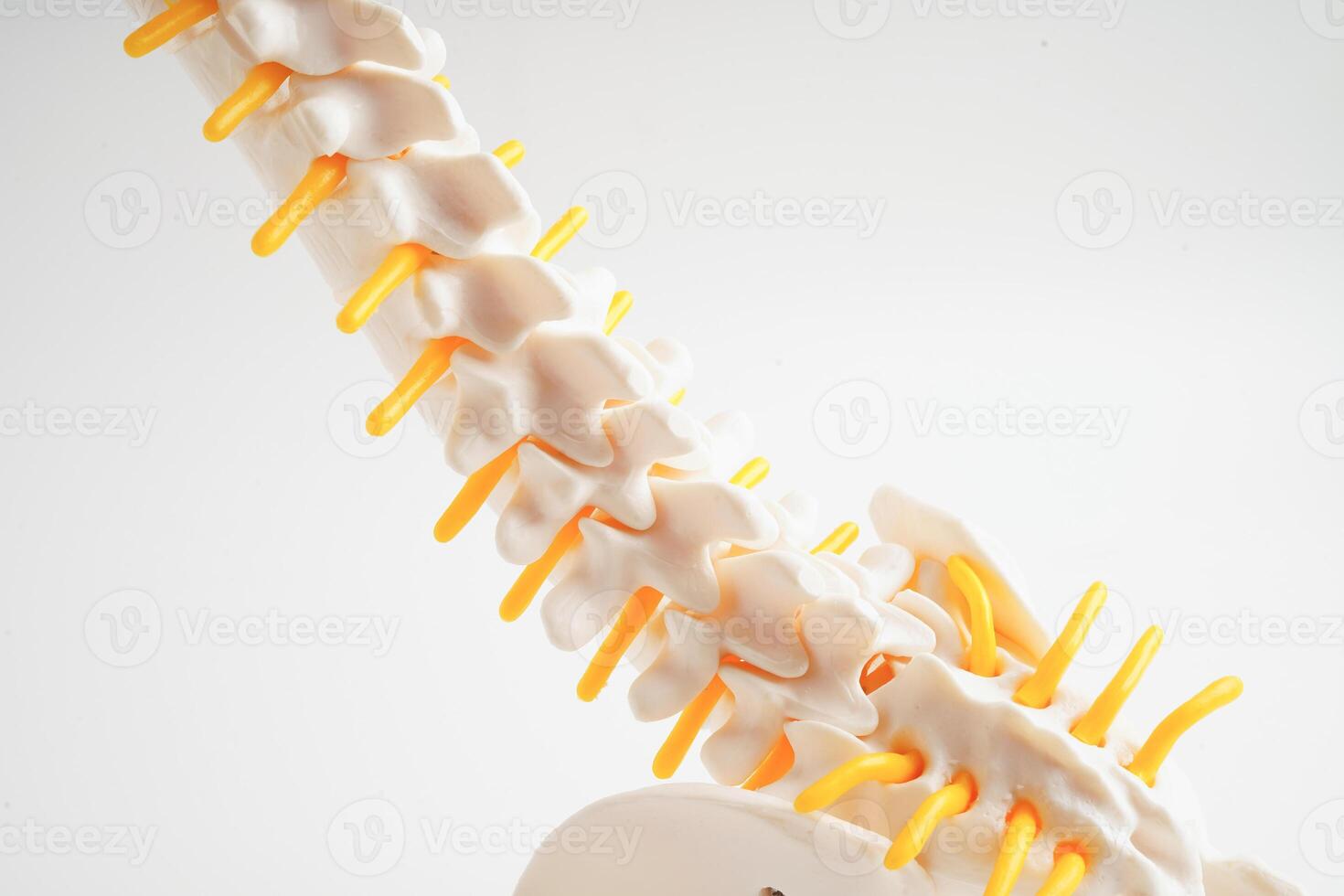 Spinal nerve and bone, Lumbar spine displaced herniated disc fragment, Model for treatment medical in the orthopedic department. photo