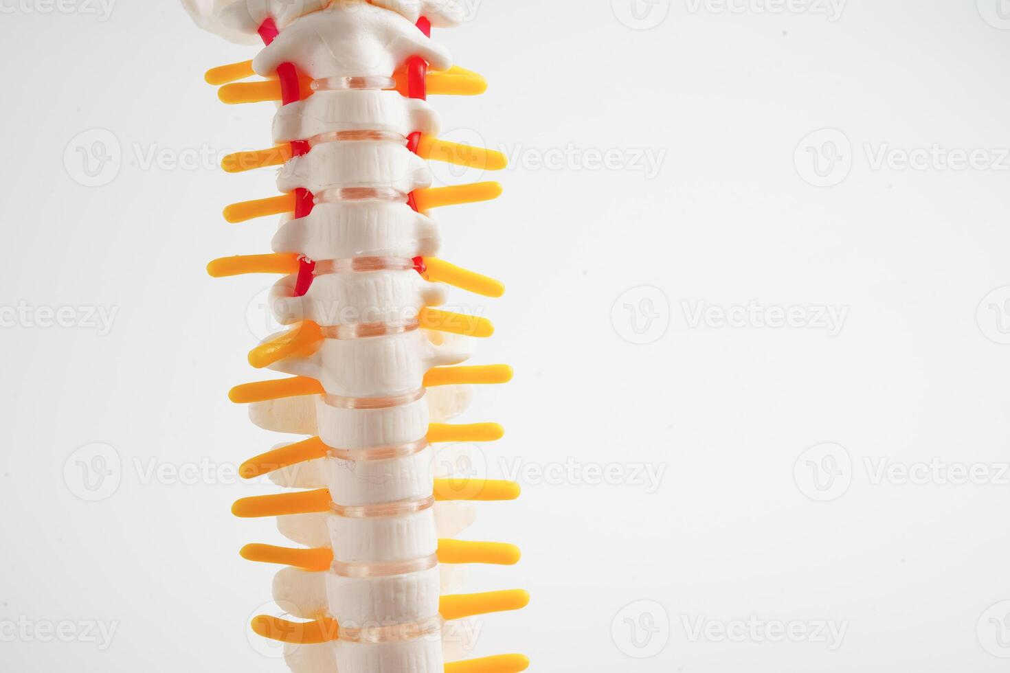 Spinal nerve and bone, Lumbar spine displaced herniated disc fragment, Model for treatment medical in the orthopedic department. photo