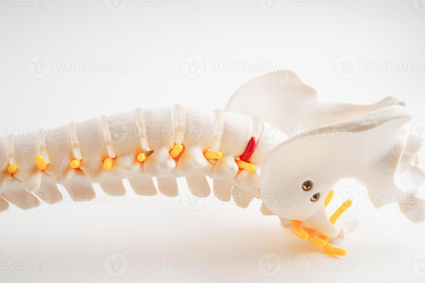 Spinal nerve and bone, Lumbar spine displaced herniated disc fragment, Model for treatment medical in the orthopedic department. photo