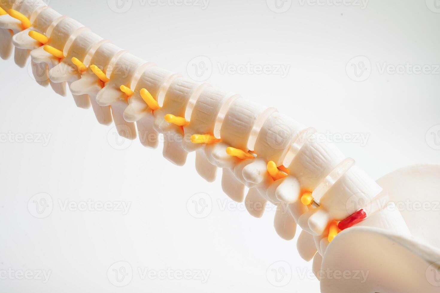 Spinal nerve and bone, Lumbar spine displaced herniated disc fragment, Model for treatment medical in the orthopedic department. photo