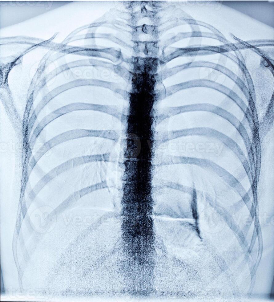 X-Ray Image Of Human Chest photo