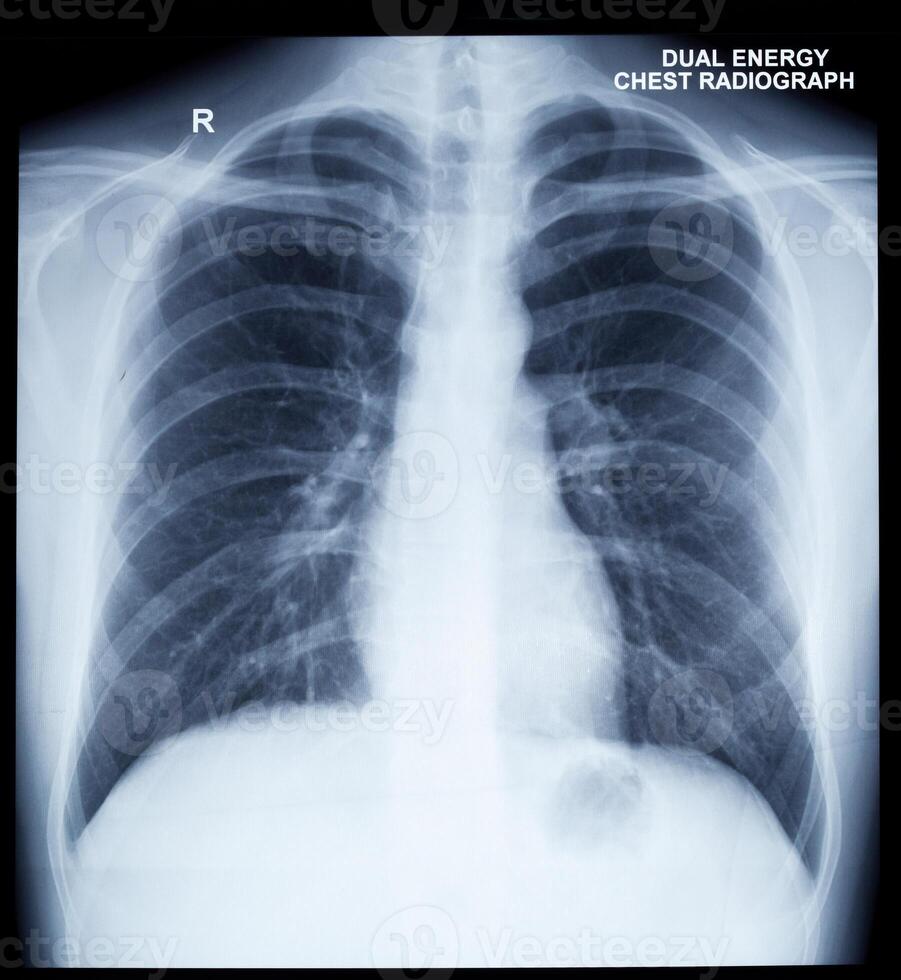 X rayo imagen de humano cofre foto