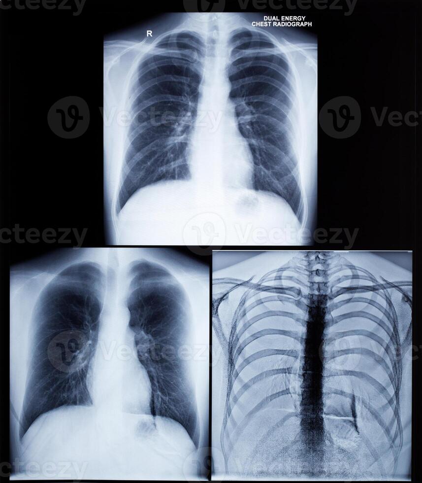 X Ray Image Of Human Chest photo