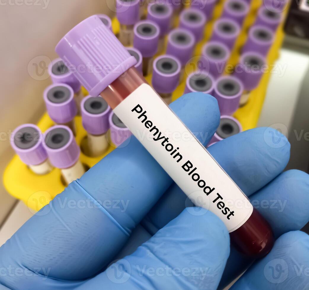 Blood sample for Phenytoin test, therapeutic drug, to maintain a therapeutic level and diagnose potential for toxicity photo