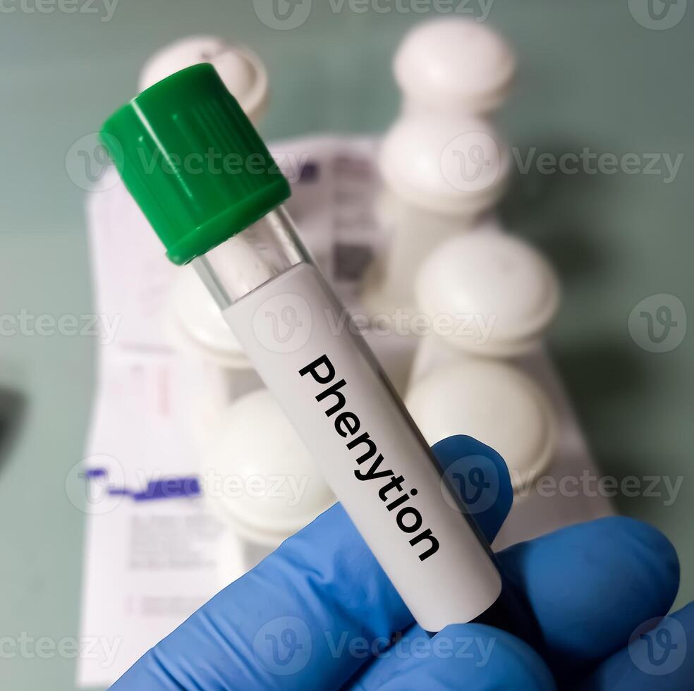 Blood sample for Phenytoin test, therapeutic drug, to maintain a therapeutic level and diagnose potential for toxicity photo