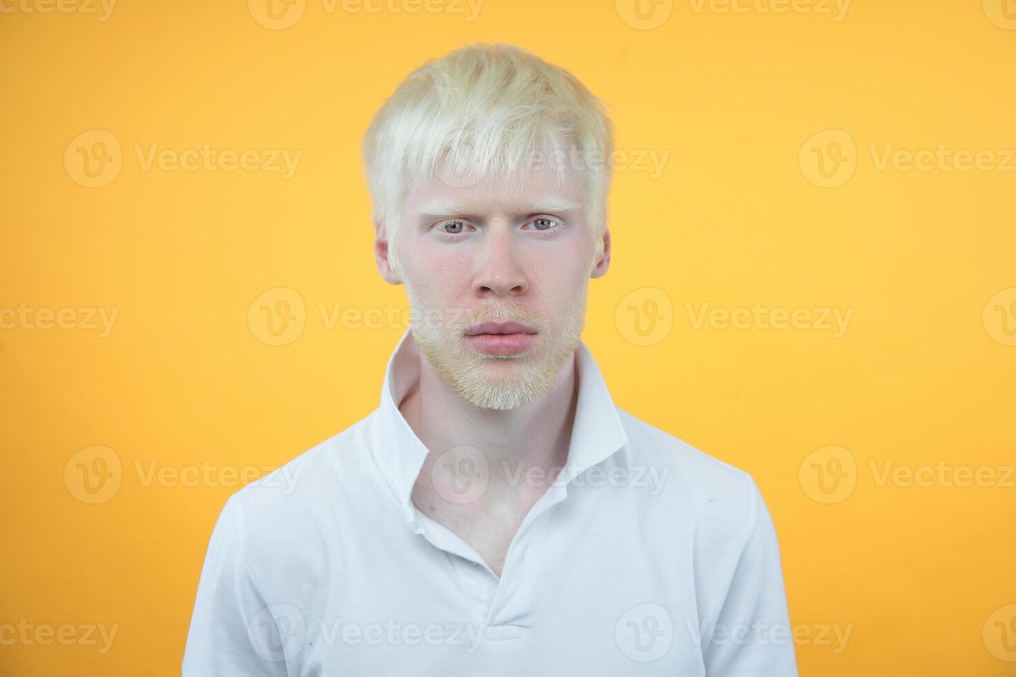 albinismo albino hombre en estudio vestido camiseta aislado en un amarillo antecedentes. anormal desviaciones raro apariencia foto