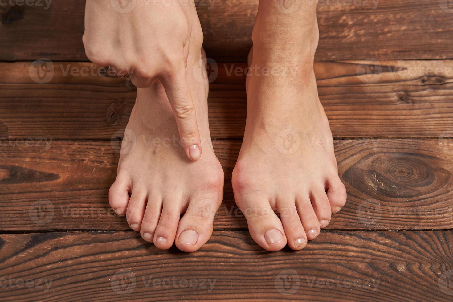 Hllux Valgus on female legs close up on wooden background photo