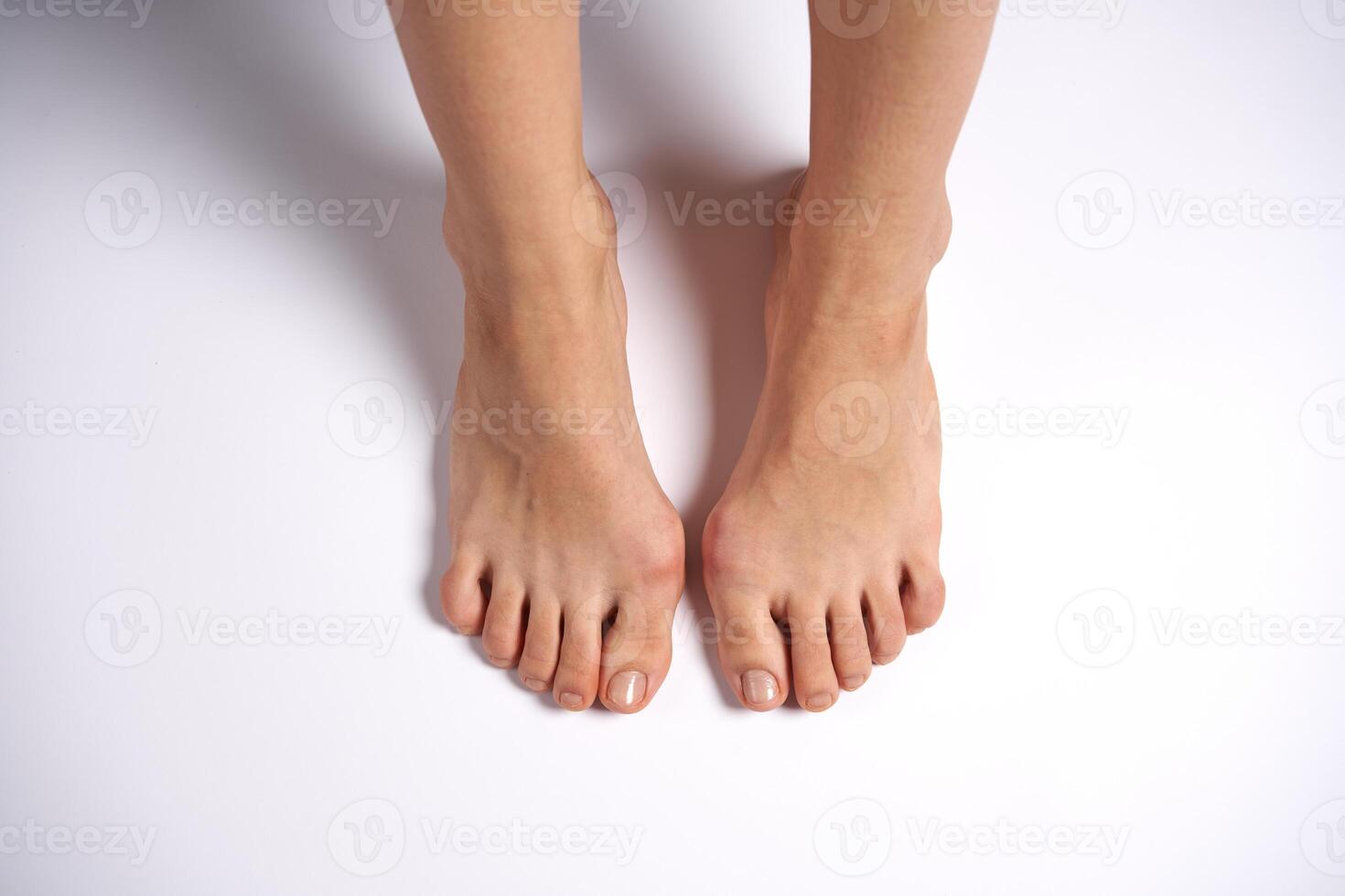 Hllux Valgus on female legs close up solated on white background photo