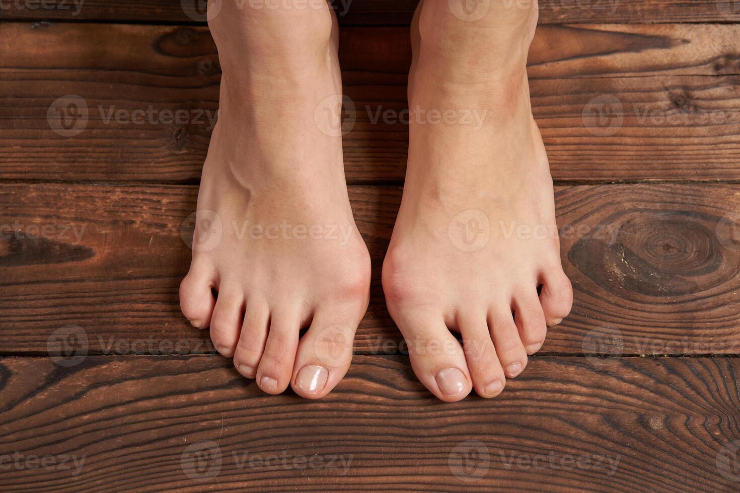 Hllux Valgus on female legs close up on wooden background photo