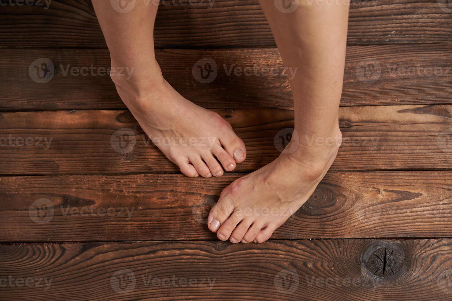 Hllux Valgus on female legs close up on wooden background photo