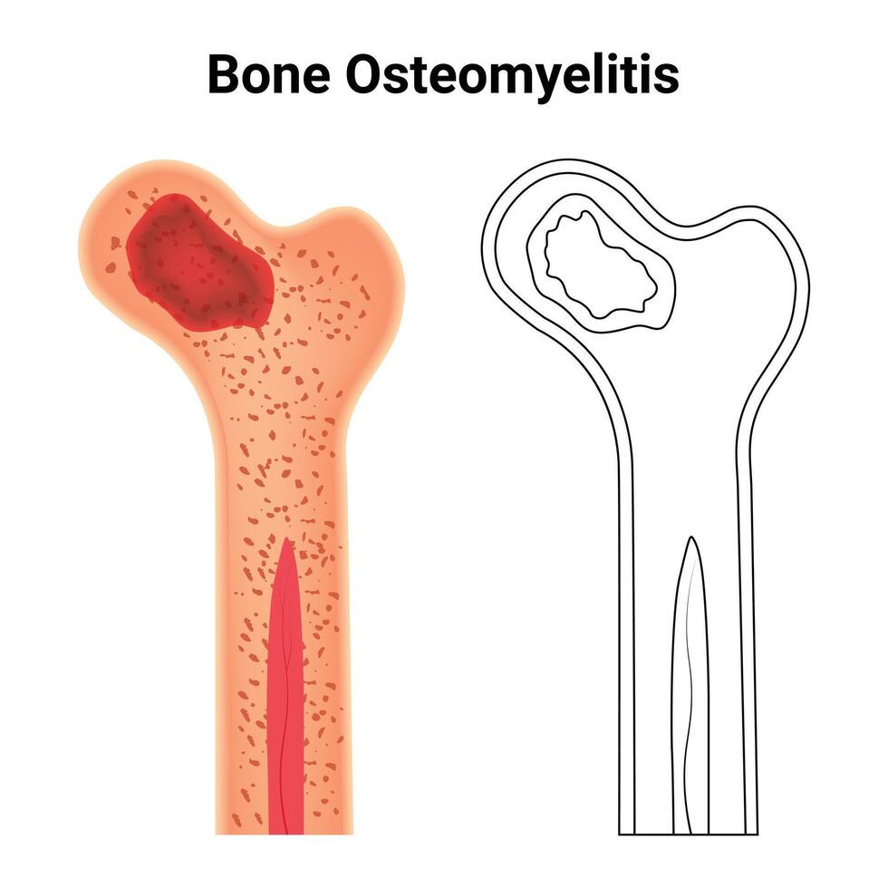 hueso osteomielitis Ciencias diseño vector ilustracion diagrama