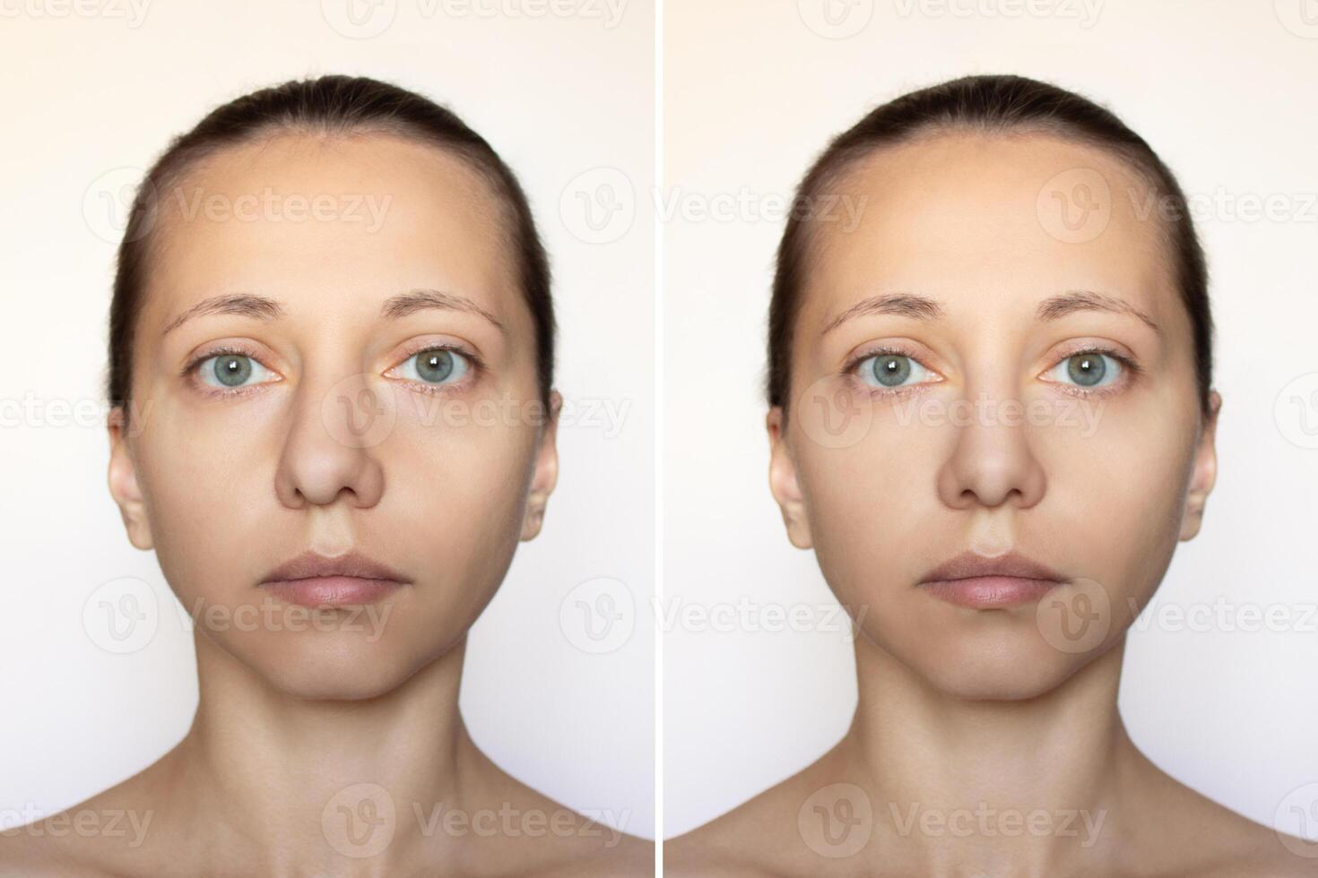 Shot of a woman's face with nose before and after rhinoplasty isolated on a white background. Cosmetic plastic surgery on the nose. Correction of the nasal septum. Septoplasty. Full face close up photo