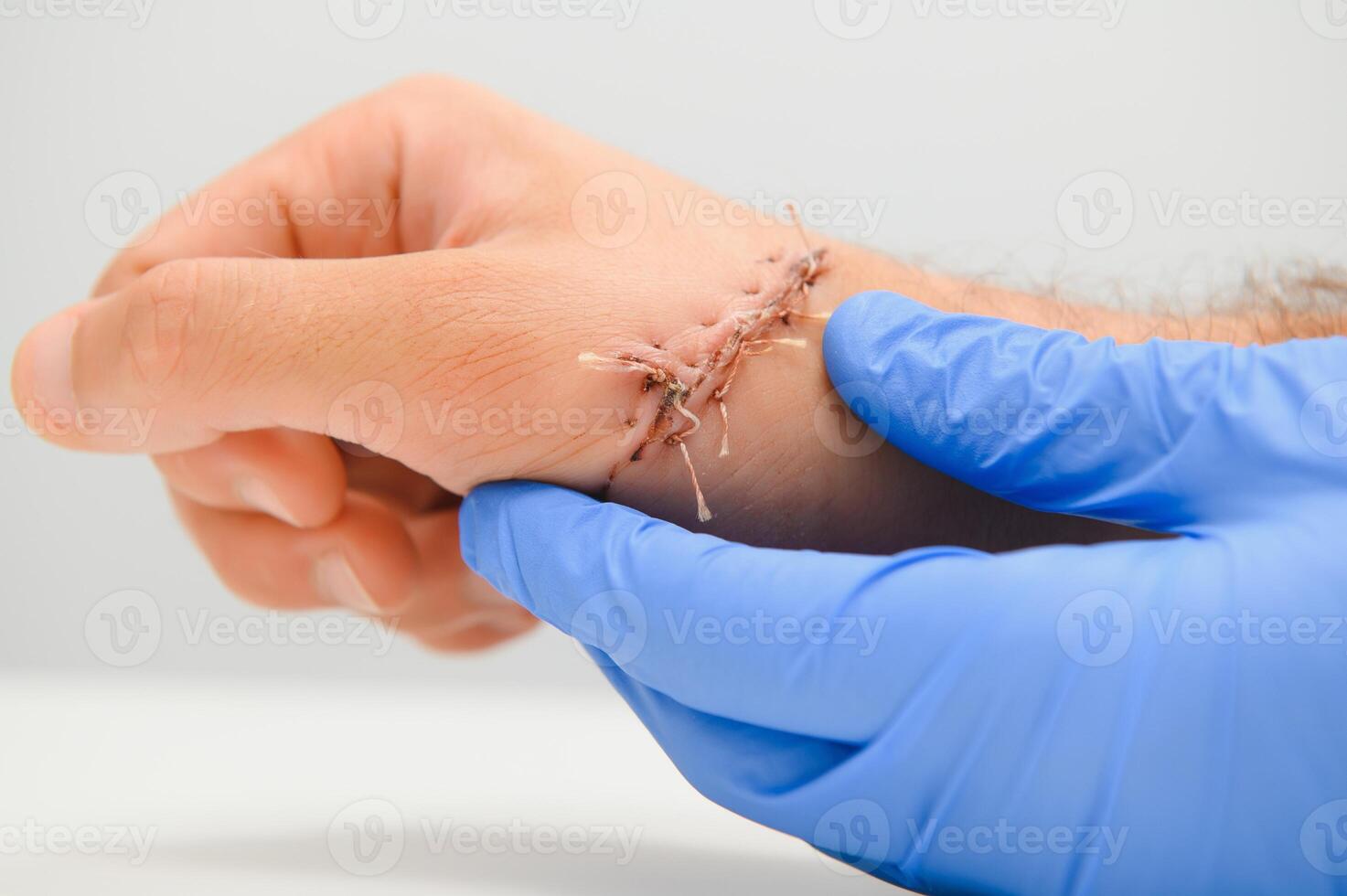 Suture wound on hand,Pain of accident concept photo