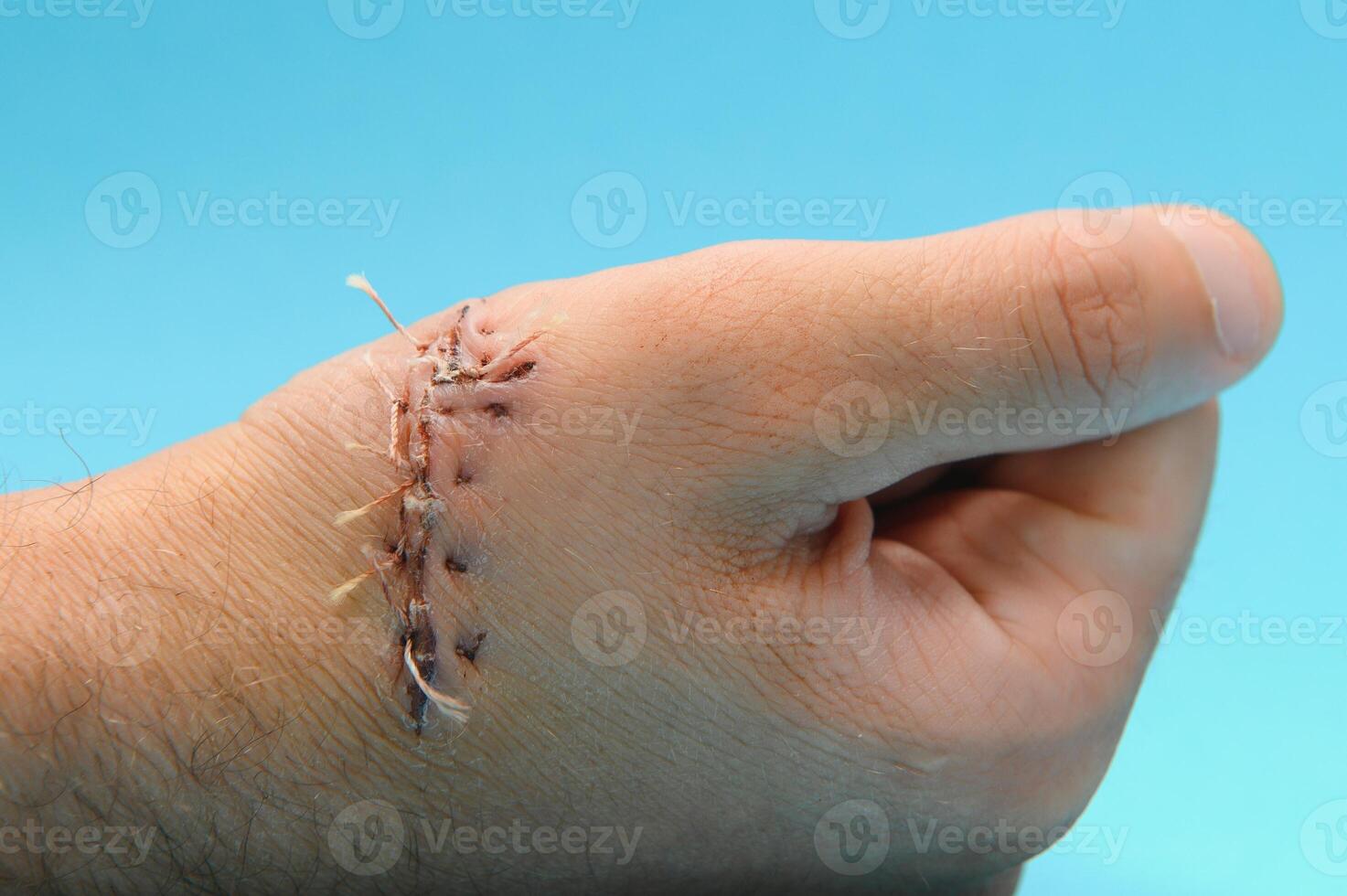 Suture wound on hand,Pain of accident concept photo