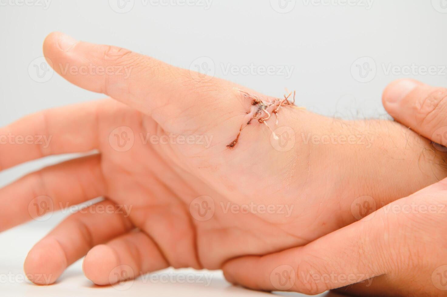 Suture wound on hand,Pain of accident concept photo