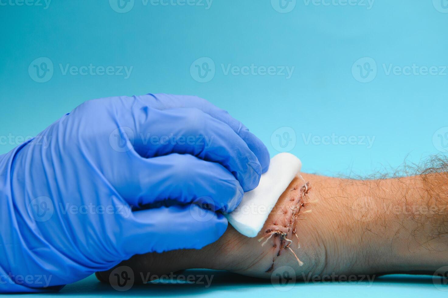 Suture wound on hand,Pain of accident concept photo