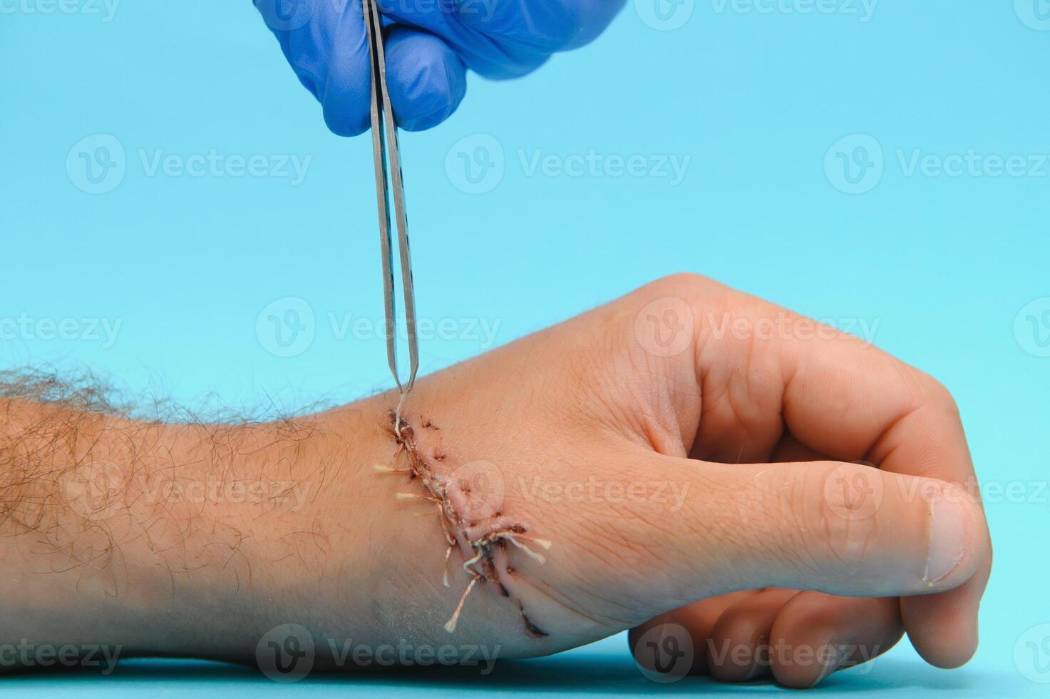 Suture wound on hand,Pain of accident concept photo