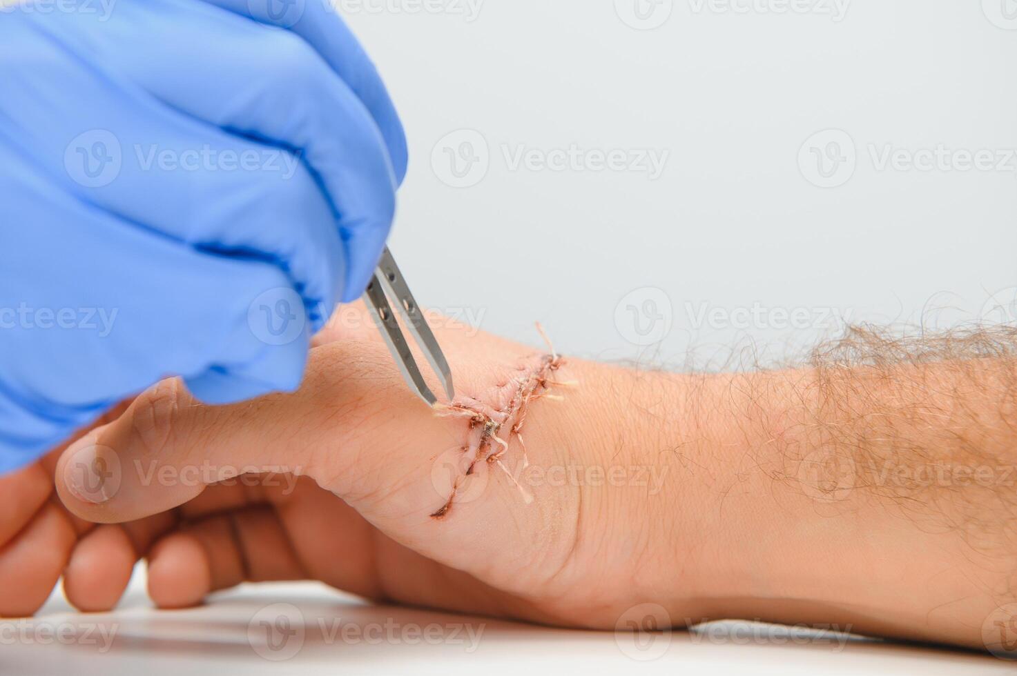 sutura herida en mano, dolor de accidente concepto foto