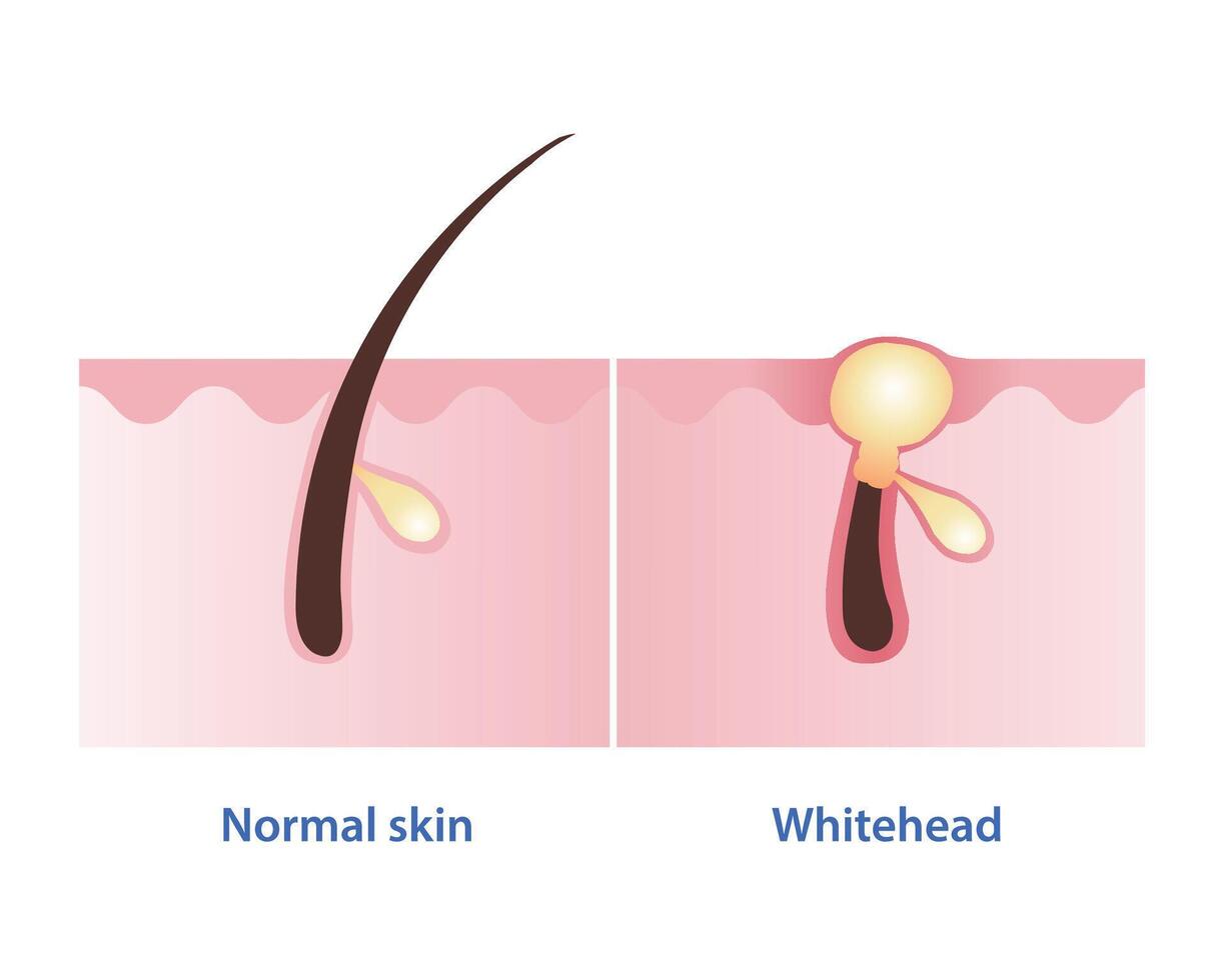 normal piel y whitehead acné vector ilustración aislado en blanco antecedentes. punto blanco, tipo de no inflamatorio espinilla. cerrado comedón. piel cuidado y belleza concepto.
