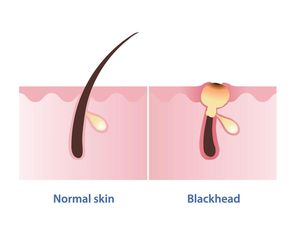 Normal skin and blackhead acne vector illustration isolated on white background. Blackhead, type of non inflammatory pimple. Open comedone. Skin care and beauty concept.