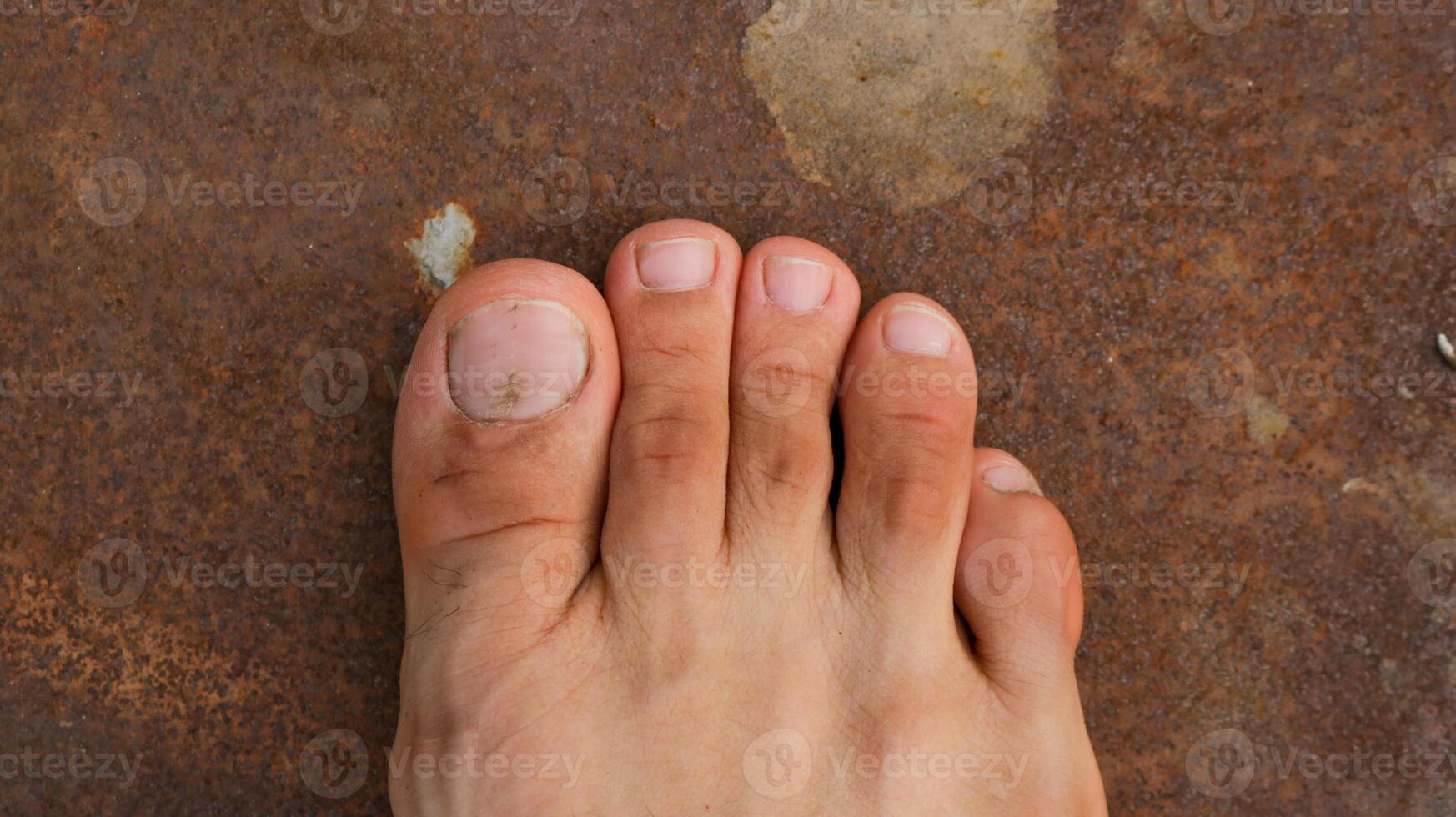 Male Foot with second toe longer than a big toe. Mortons's toe, Greek foot or Royal toe or Aboriginal feet photo