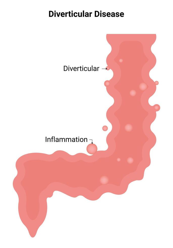 Diverticular Disease Science Design Vector Illustration Diagram