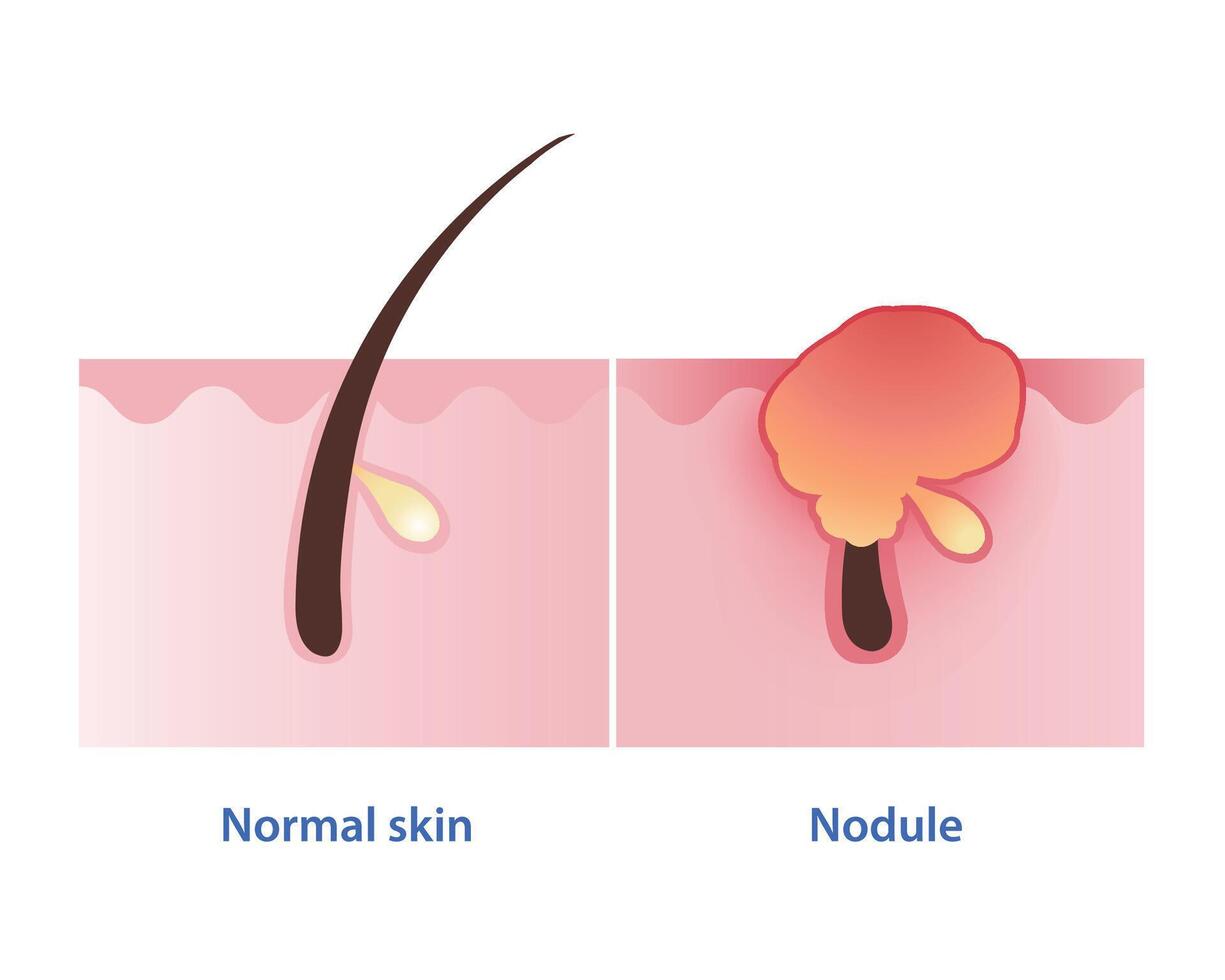 Nodule, type of inflammatory acne vector on white background. Normal skin and nodular acne is firm, painful lump to form under your skin and red bump is inflamed to appear on the skin surface.