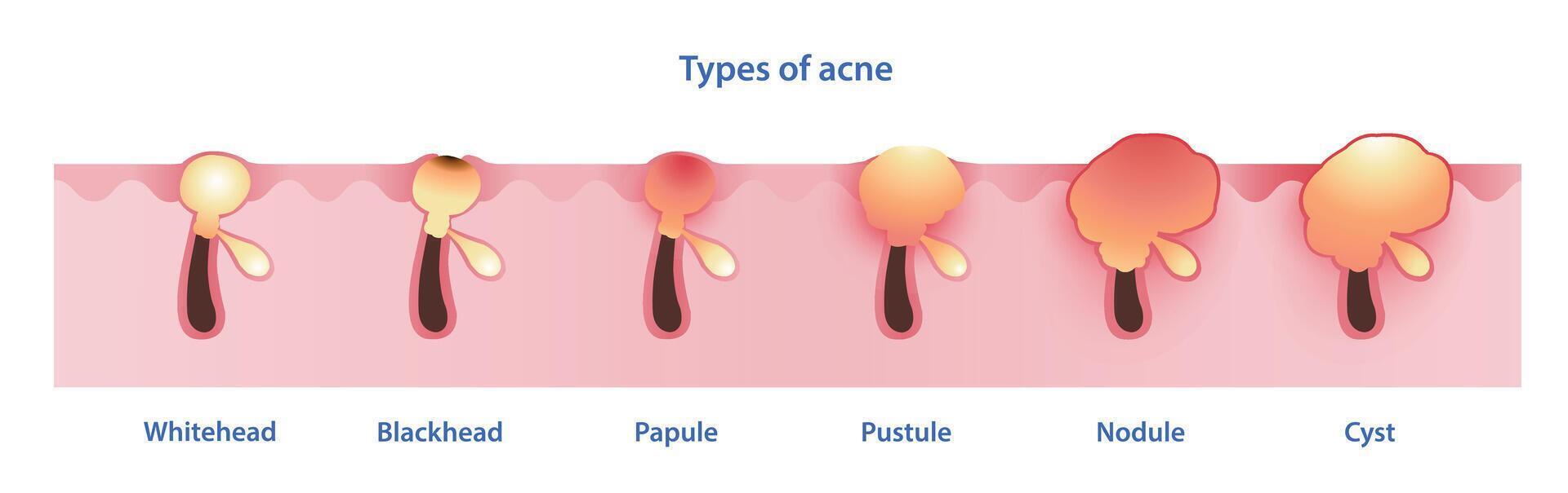 tipos de acné vector en blanco antecedentes. formación de no inflamatorio acné, punto blanco, espinilla, inflamatorio acné, pápula, pústula, nódulo y quiste. piel cuidado y belleza concepto ilustración.