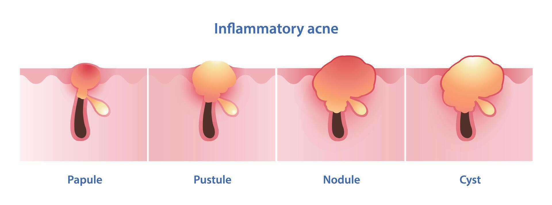 diagrama de inflamatorio acné tipos vector ilustración aislado en blanco antecedentes. pápula, pústula, nódulo, nodular, noduloquístico, cístico acné y quiste. piel cuidado y belleza concepto.