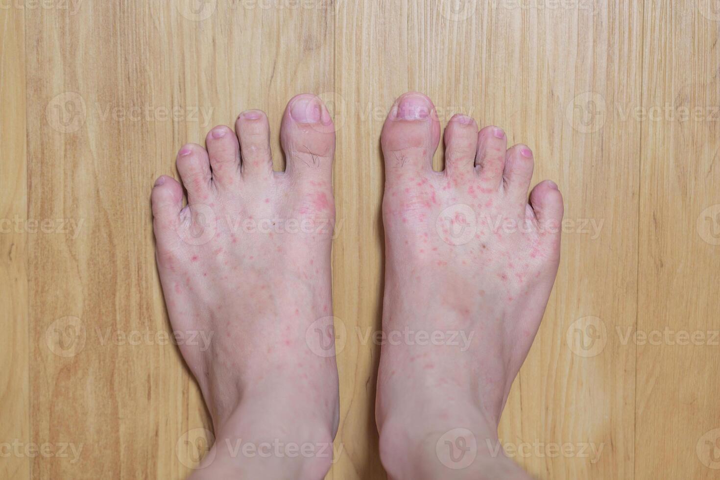 Allergic reaction, Red rash itychy on foot photo