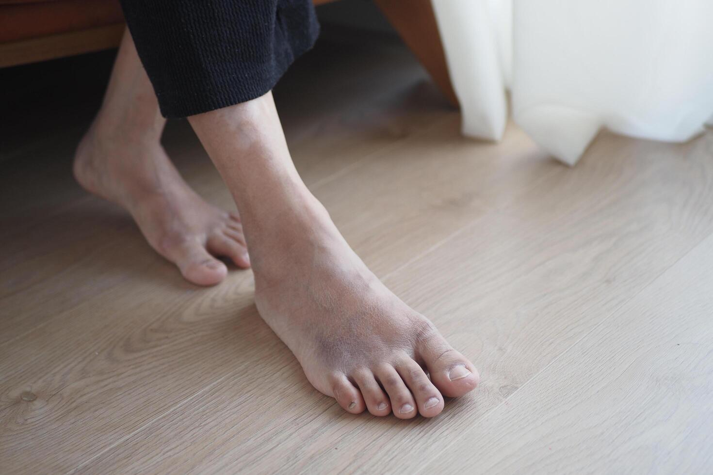 close up of women feet with swelling photo