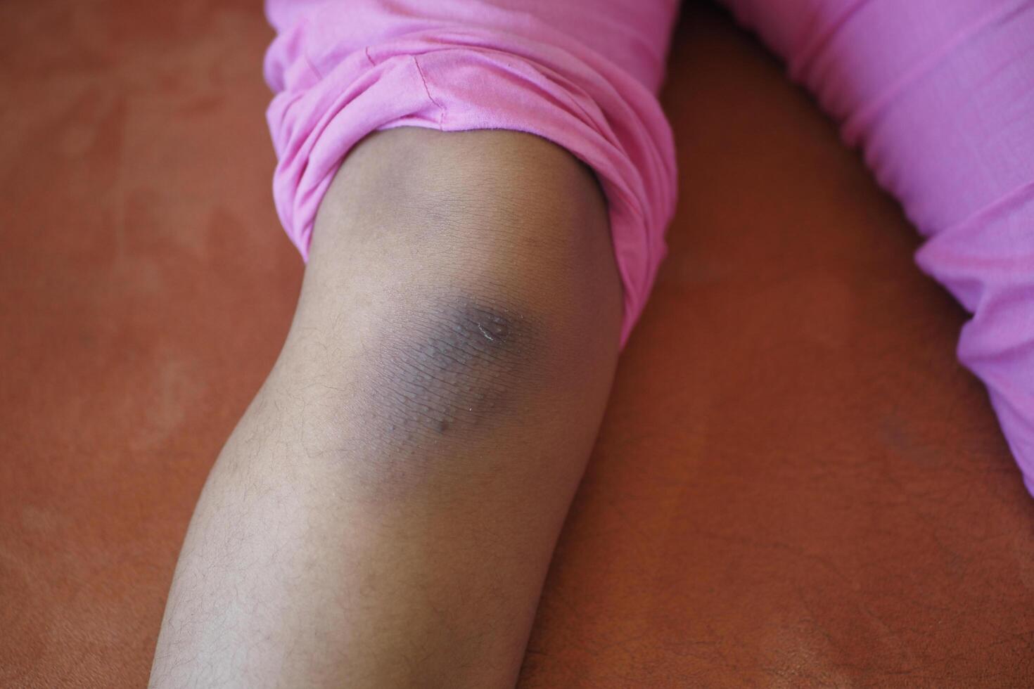 stain bruise wound on kid knee. photo