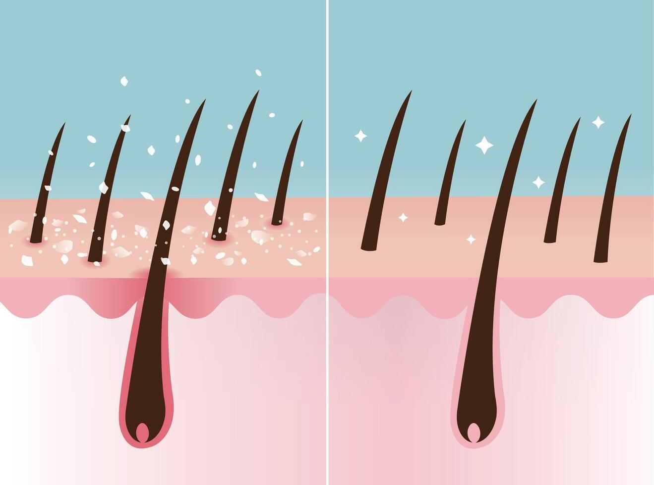 Comparison of dandruff and healthy hair on scalp layer vector illustration. Cross section of scaly scalp, white dry flaky in hair and nourished hair. Hair care and problem concept.