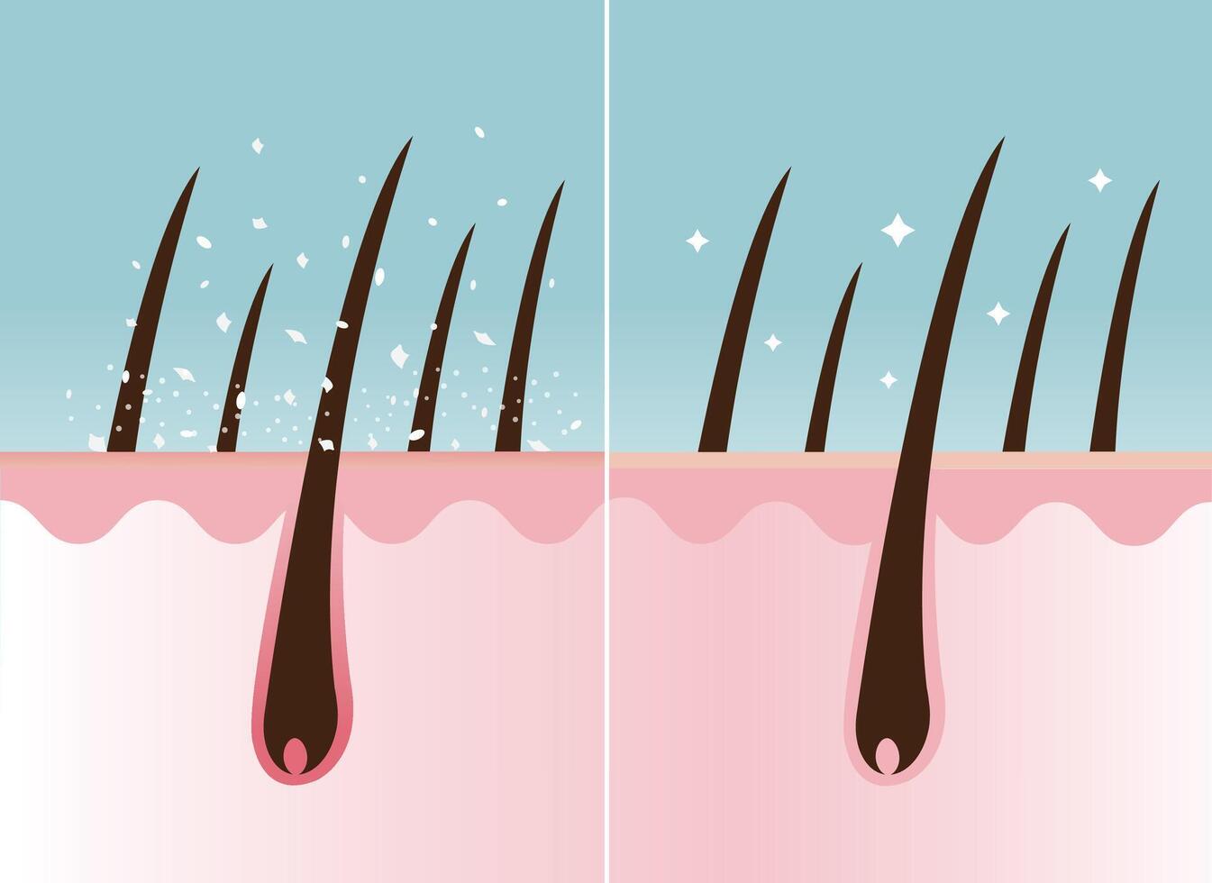 Comparison of dandruff in hair and healthy hair on scalp layer vector illustration. Hair with white dry flaky, scaly scalp and nourished. Hair care and problem concept.