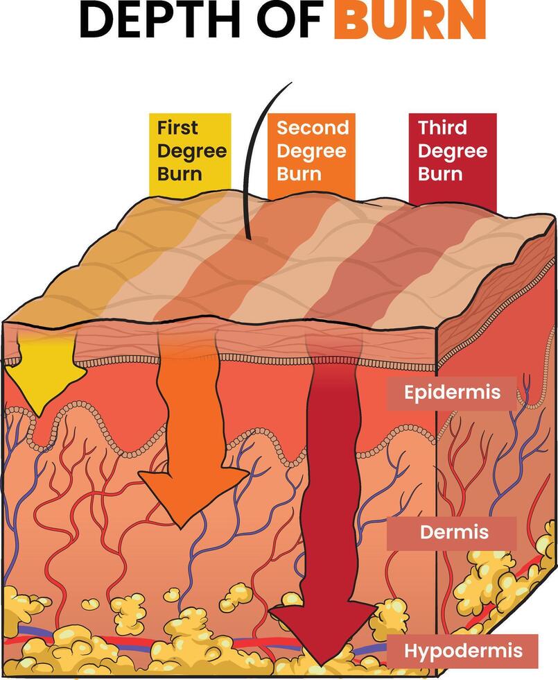 depth of burn diagram diagram vector